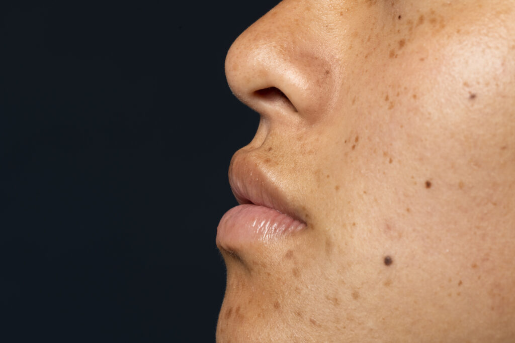 melasma no rosto