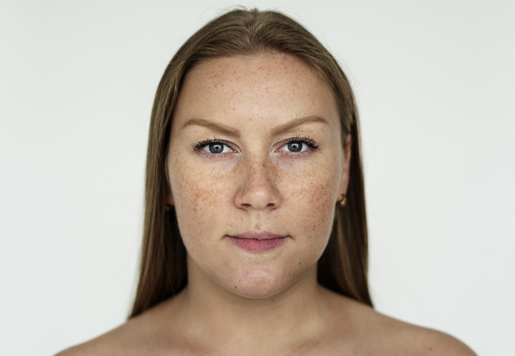 melasma no rosto
